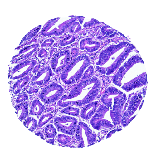 Human Tissue Microarray Colorectal Tumor Tissue Microarray (53 cases) – TC003 Colorectal Tumour Tissue Microarray (53 cases) – TC003