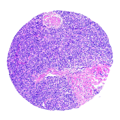 Thymic Tumour Tissue Microarray (20 cases) – TTM002 Thymic Tumour Tissue Microarray (15 cases) – TTM002
