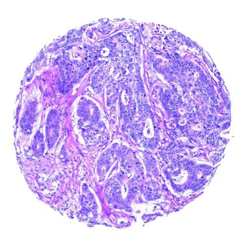 Caecal Tumour Tissue Microarray (17 cases) – TCC001 Caecal Tumour Tissue Microarray (17 cases) – TCC001