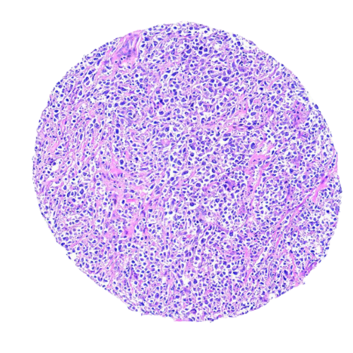Lymphoma Tumour Tissue Microarray (43 cases) – TLY001 Lymphoma Tumour Tissue Microarray (43 cases) – TLY001
