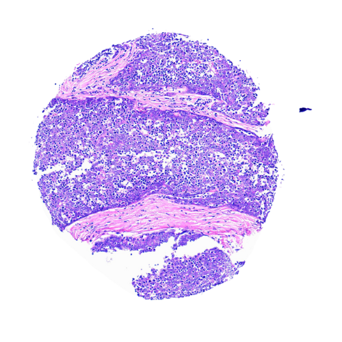 Thymic Tumour-Matched Adjacent Tissue Microarray (19 cases) – TTM001 Thymic Tumour-Matched Adjacent Tissue Microarray (19 cases) – TTM001