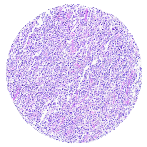 Lymphoma Tumour Tissue Microarray (63 cases) – TLY002 Lymphoma Tumour Tissue Microarray (63 cases) – TLY002