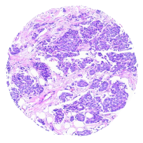 Breast Tumour Tissue Microarray (59 cases) – TB003 Breast Tumour Tissue Microarray (59 cases) – TB003