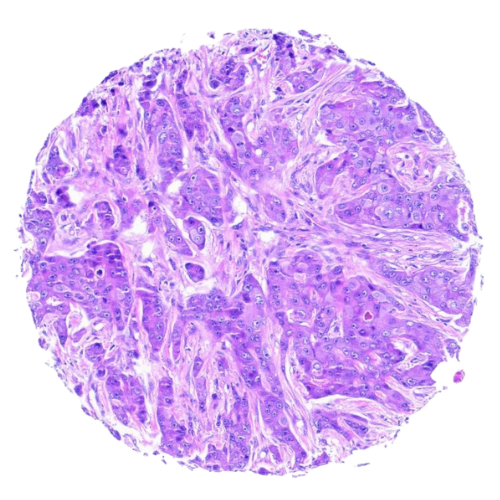 Breast Tumour Tissue Microarray (62 cases) – TB002 Breast Tumour Tissue Microarray (62 cases) – TB002